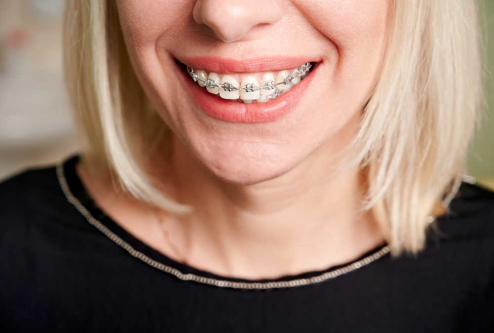 Adult woman in silver braces
