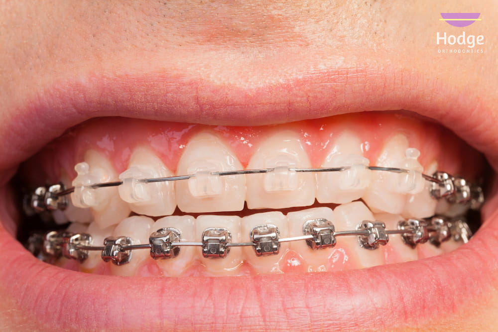 Clear Braces vs Metal Braces in Little Rock, AR