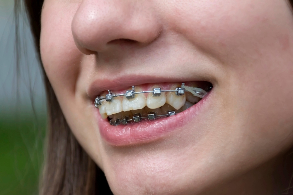 Close-up of a smiling patient showing metal braces on teeth – braces for overbite in little rock, ar.