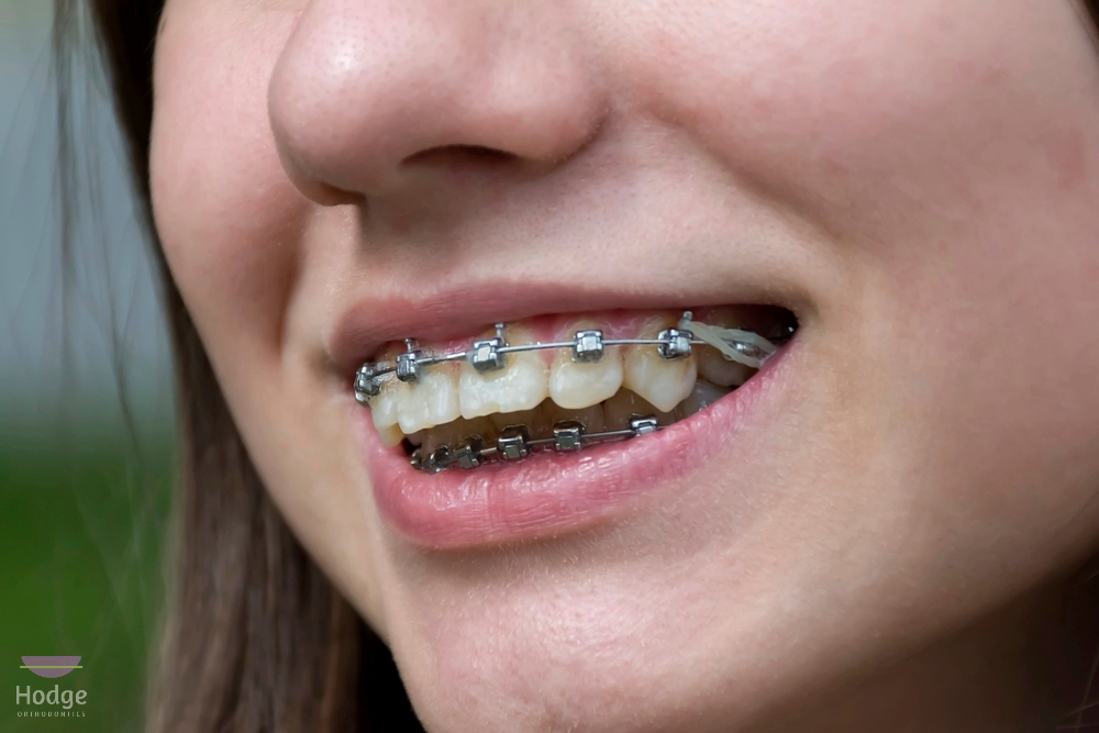 smiling girl metal braces her teeth - Overbite vs Underbite in Little Rock, AR.